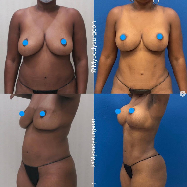 Non Invasive Breast lift Houston TX